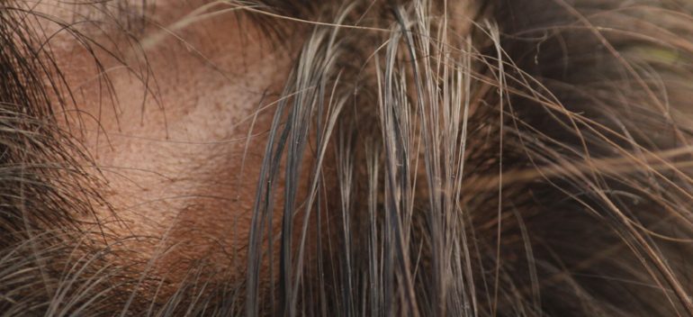 Alopecia Areata: diagnóstico y tratamiento