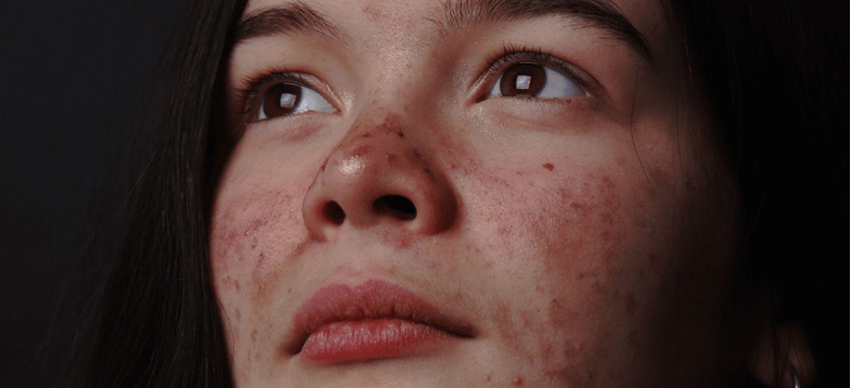 Imagen acné y síndrome poliquístico