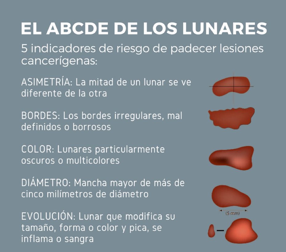 melanoma: ABCDE DE LOS LUNARES