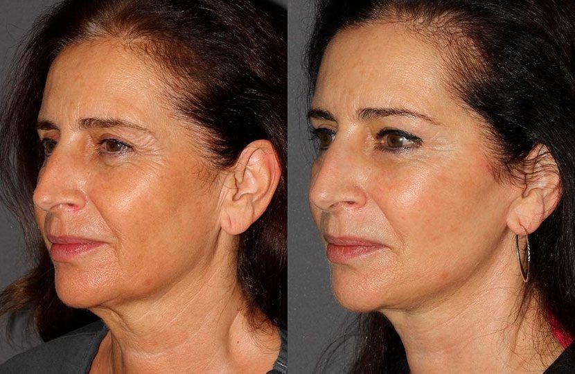 Imagen resultados tratamiento lifting facial