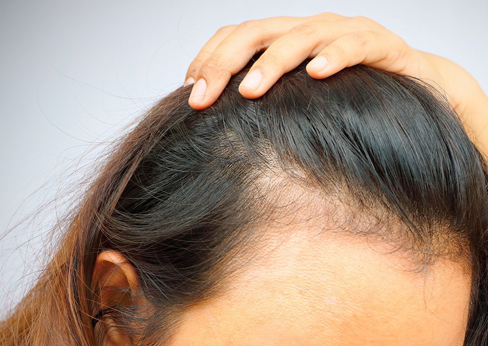 Solución patología Alopecia frontal fibrosante IMR