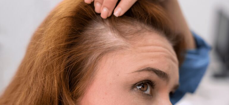 ¿Cómo evitar la caída de pelo en mujeres?