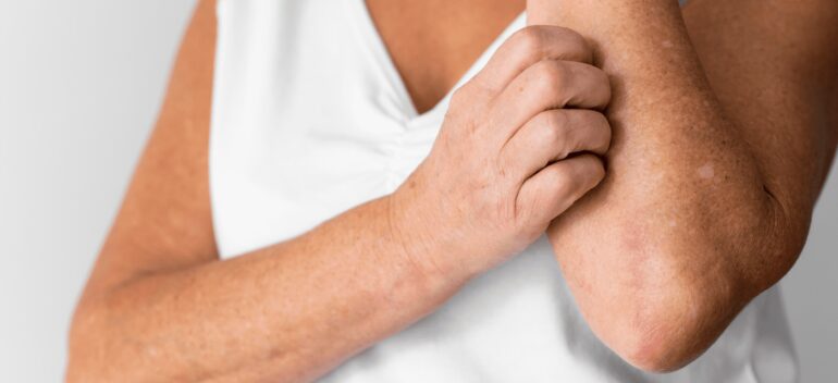 Tipos de dermatitis más comunes: Dermatitis atópica y dermatitis seborreica