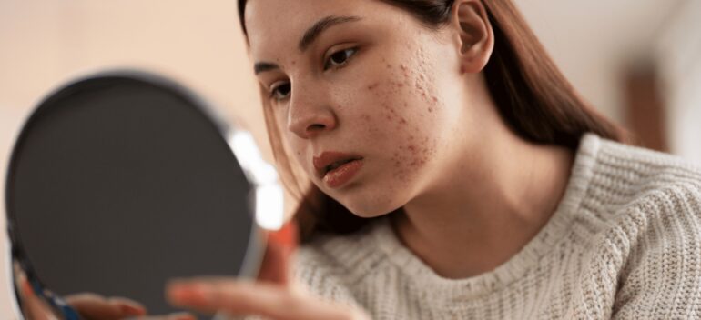 Tratamiento para el acné juvenil: ¿cómo eliminarlo?