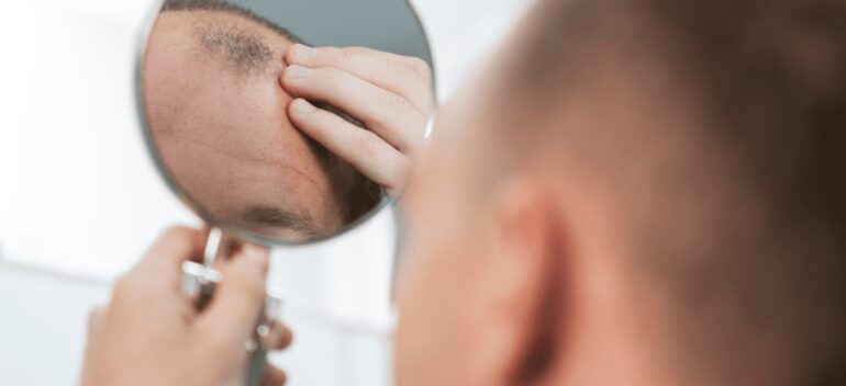 Alopecia cicatricial: Causas, diagnóstico y tratamiento