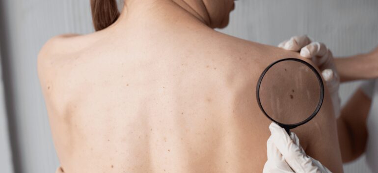 ABCDE melanoma: ¿Qué signos alertan de un posible cáncer de piel?