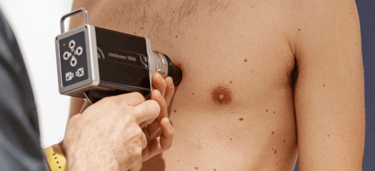 ABCDE melanoma: ¿Qué signos alertan de un posible cáncer de piel?