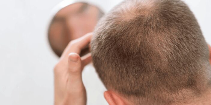 Entradas en el pelo: ¿Cómo mejorar su estética?