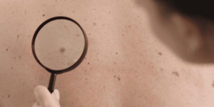 Qué tipos de nevus existen