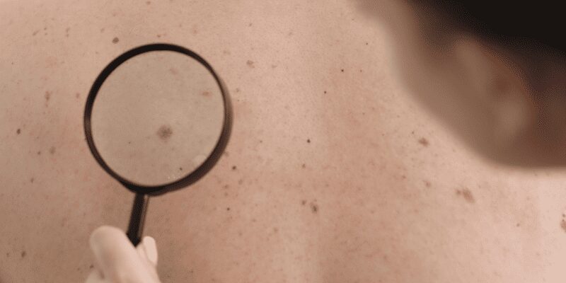 Tipos de nevus