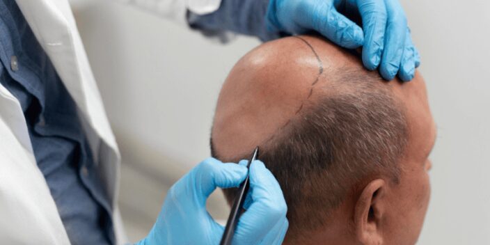 Operación capilar: Claves para una óptima recuperación