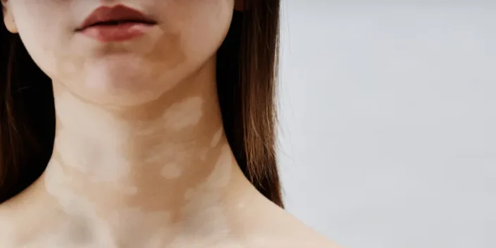 Pitiriasis versicolor: Qué es, síntomas y tratamiento