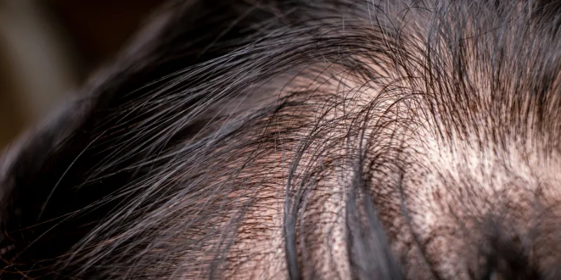 Hemangioma capilares