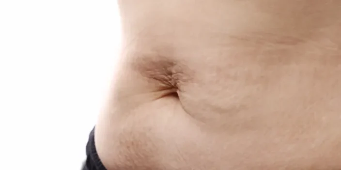 Abdomen flácido y arrugado: ¿Cuáles son los mejores tratamientos para mejorar su aspecto?