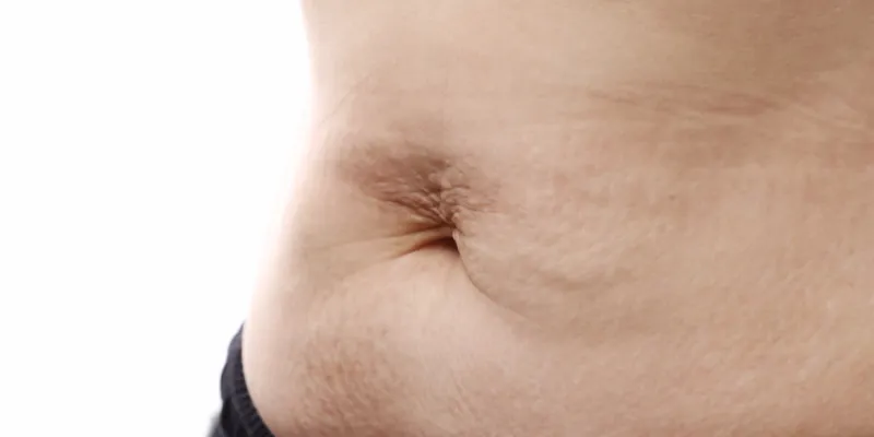 abdomen flácido y arrugado