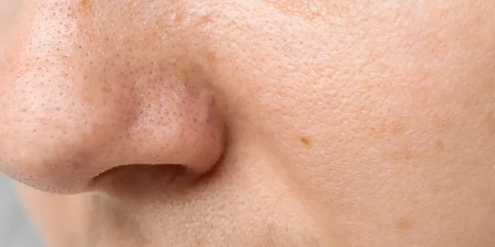 ¿Cómo tratar los poros abiertos en la cara?