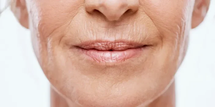 Arrugas labio superior: Tratamiento para eliminarlas