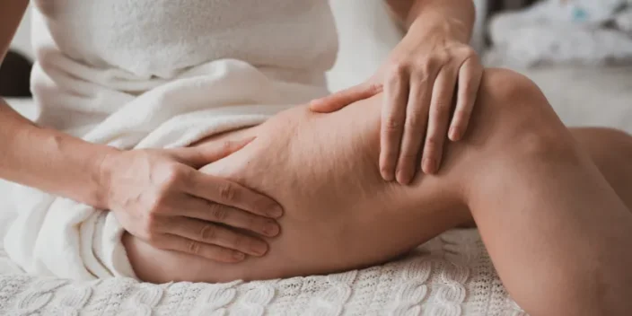 Flacidez piernas: Tratamientos, ejercicios y consejos