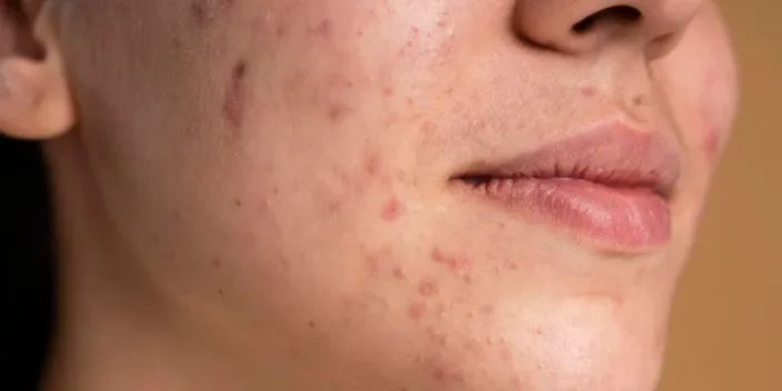 Eliminar cicatrices de acné profundas: Mejores tratamientos