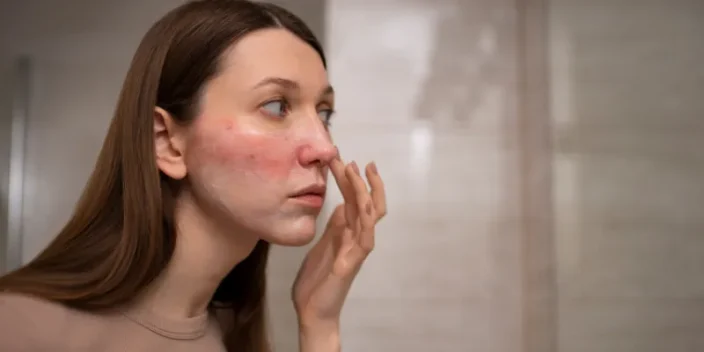 Rojeces en la cara: ¿Cómo tratarlas?