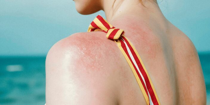 Alergia al sol