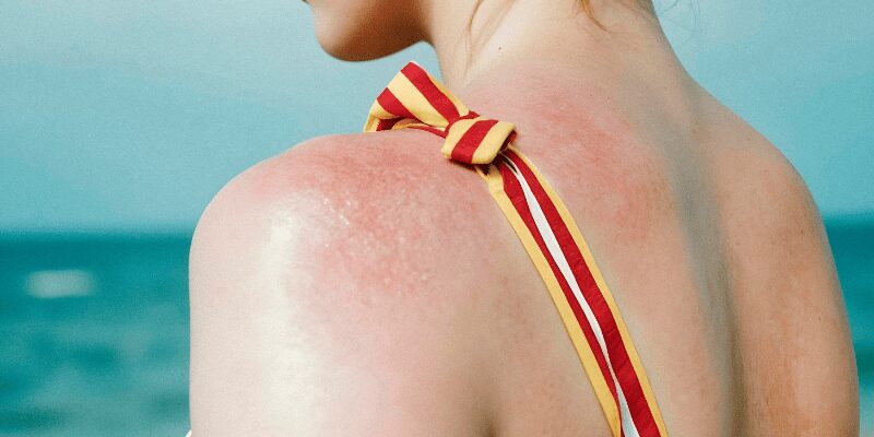 Alergia al sol