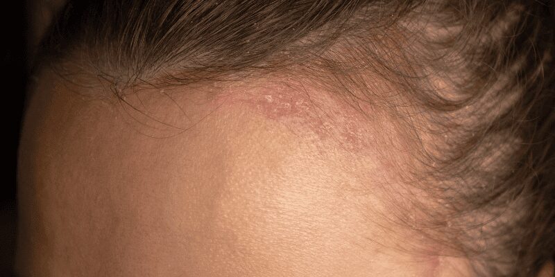dermatitis en el cuero cabelludo​