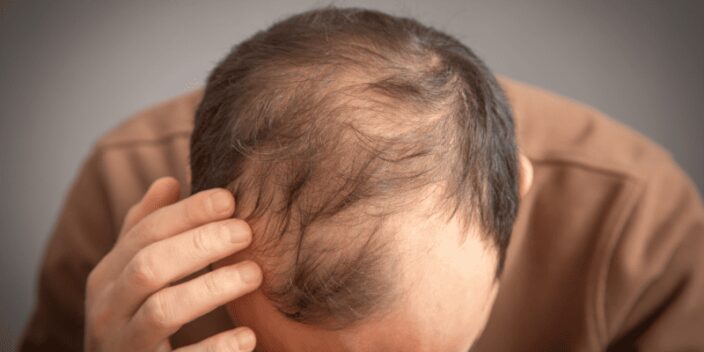 ¿Qué tipos de alopecia hay?